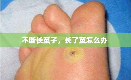 不断长茧子,长了茧怎么办
